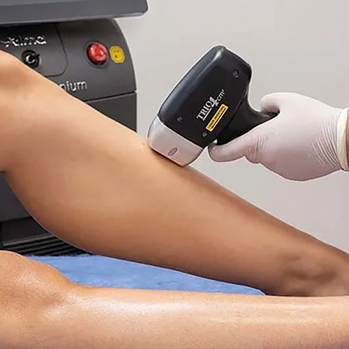 Foto di una epilazione laser su una gamba, senza controindicazioni